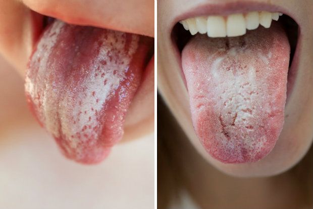 Oral thrush: patient management and prevention | Chemist+Druggist